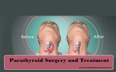 Parathyroid Diseases and Treatments Southlake - Southlake General Surgery