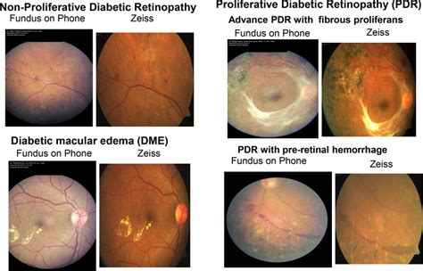 Retinal images of diabetic retinopathy obtained in fundus on phone ...