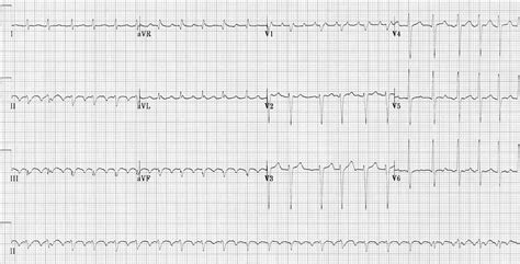 Atrial Flutter • LITFL • ECG Library Diagnosis