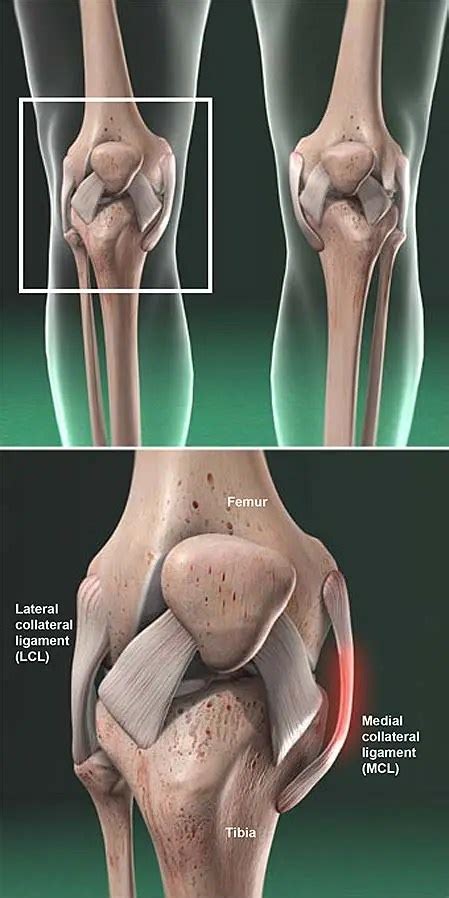 Lesión del ligamento colateral mediano (MCL) | Grupo médico ortopédico de la costa central