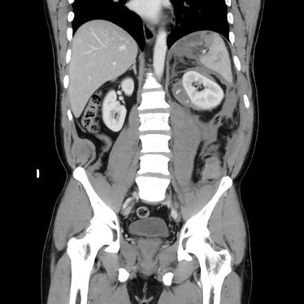 Blunt abdominal trauma with solid organ and musculoskelatal injury with ...