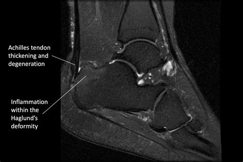 Achilles Tendonitis — Daniel Bohl, MD | Midwest Orthopaedics at RUSH