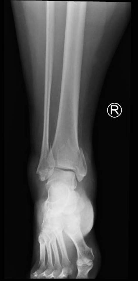 Trimalleolar Fracture, AP XRay. JETem 2016 - JETem