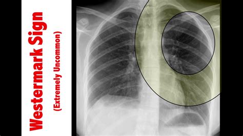 Pulmonary Embolism Chest X Ray