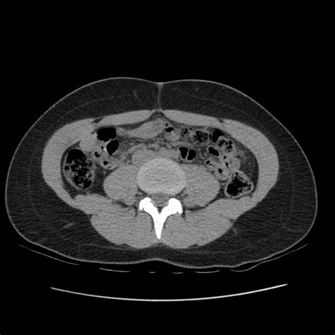 Normal CT abdomen and pelvis triphasic protocol Image