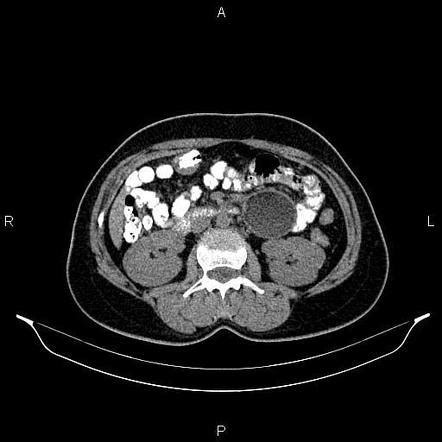 Mesenteric cyst | Image | Radiopaedia.org