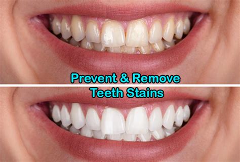 Prevent & Remove Teeth Stains - Regent Dental Cambridge