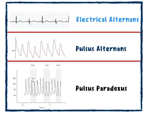 Pulsus Alternans |Causes |Signs & Symptoms - Nurseship.com