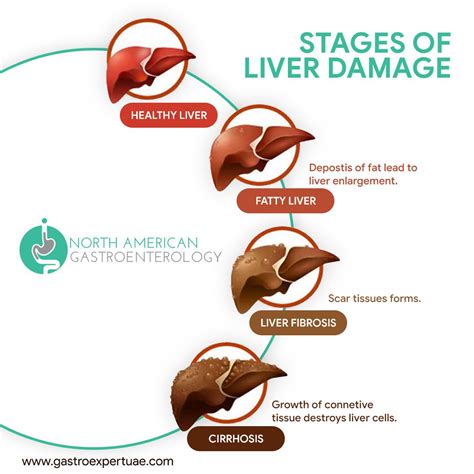 Stages Of Liver Damage Liver Health Liver Cirrhosis | Free Nude Porn Photos