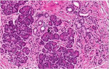 Asymptomatic heterotopic pancreas in Meckel’s diverticulum: a case report and review of the ...