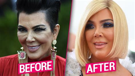 Kris Jenner's Plastic Surgery Makeover Exposed By Top Docs