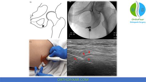 Ischial Bursitis Injection - Easy Tutorial | OrthoFixar 2024