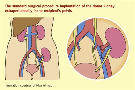 Renal transplantation - Medicine