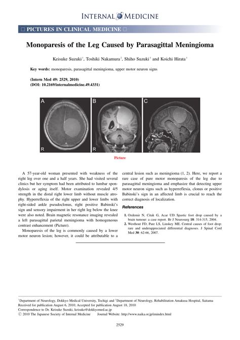 (PDF) Monoparesis of the Leg Caused by Parasagittal Meningioma