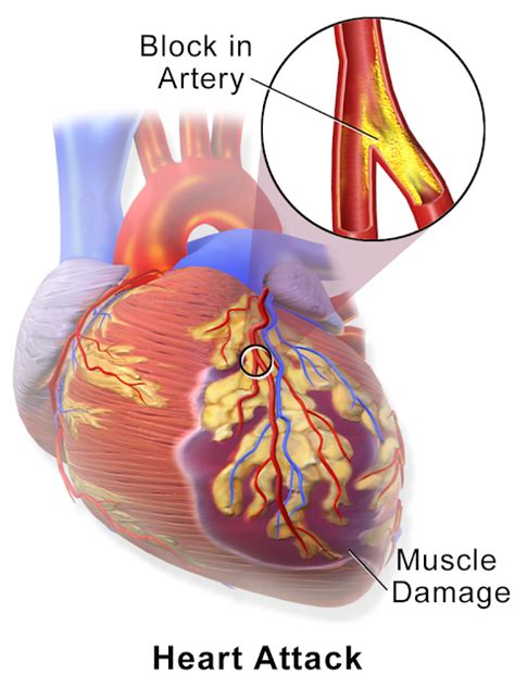 The ZerrKing: Calcium in arteries influences heart attack risk