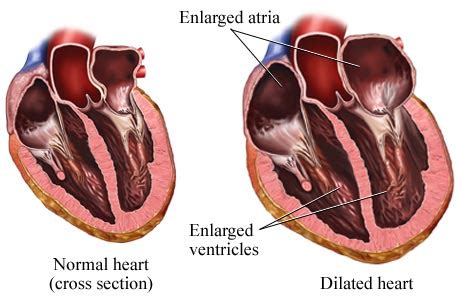 Hypertensive Heart Disease – Symptoms, Treatment, Causes