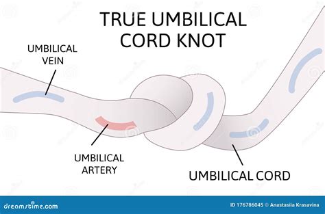 True Umbilical Cord Knot. Umbilical Cord Forms a Knot Inside the Womb Stock Illustration ...