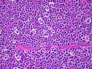 Burkitt lymphoma - Libre Pathology