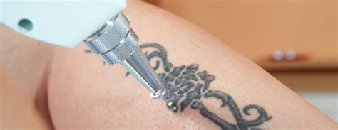 Laser Tattoo Removal: Top Reasons Why You Should Get It - Dylan Dog ...