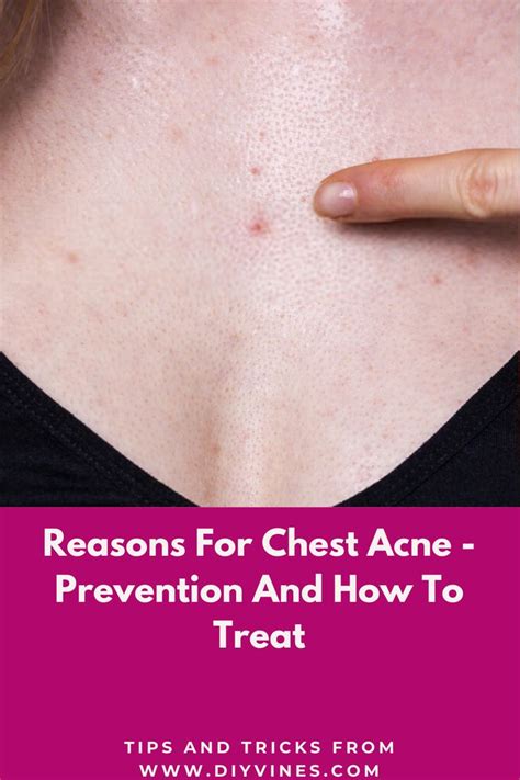 Reasons For Chest Acne - Prevention And How To Treat | Chest acne, Bad ...