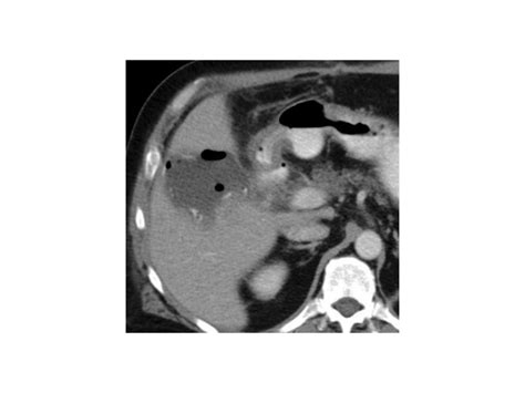 Benign liver masses 8.31.11