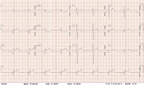 Epänormaalit EKG-löydökset nuorella potilaalla, jolla oli selittämätön ...