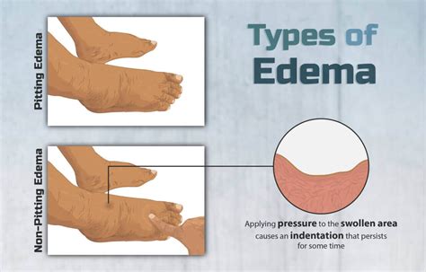 What Is Edema: 6 Types, Symptoms, And Causes » 2022