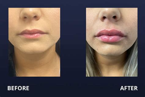 Restylane Lips Before And After Photos | Lipstutorial.org