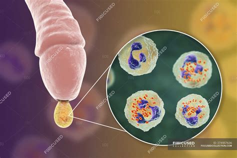 O Que é Gonorreias Imagens - SOLOLEARN