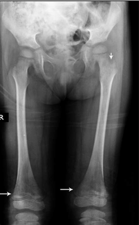 Bony Lesions in Pediatric Acute Leukemia: Pictorial Essay | Iranian Journal of Radiology | Full Text