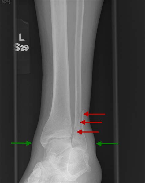 Fracture fibula - daQas