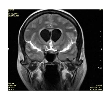 What Are the Signs and Symptoms of Cronobacter Infection? - StoryMD