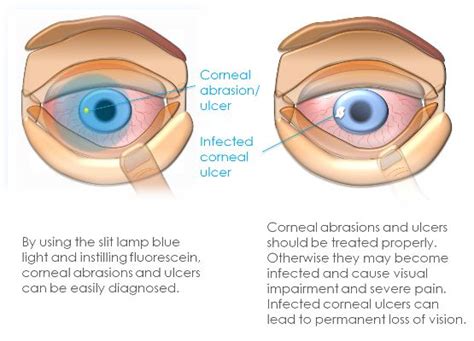 Corneal Ulcer: Causes, Symptoms, Diagnosis & Treatment » How To Relief