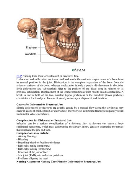 Nursing Care Plan for Dislocated or Fractured Jaw. Dislocation and