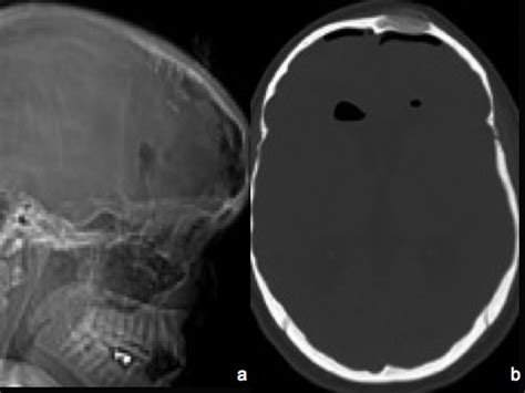 Another calvarial hemangioma in young women presenting with frontal ...