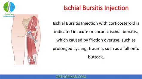 Ischial Bursitis Injection - Easy Tutorial | OrthoFixar 2024