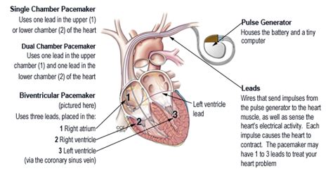 Permanent Pacemaker | Cleveland Clinic