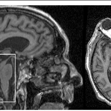 MRI of a patient with a clinical diagnosis of Progressive Supranuclear... | Download Scientific ...