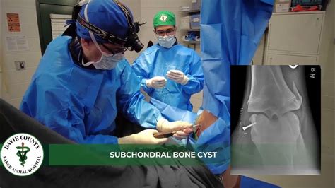 DCLAH Services - Subchondral Bone Cyst Surgery - YouTube