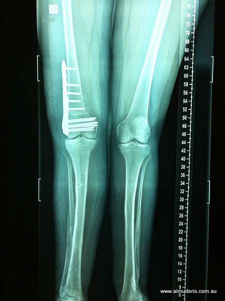 Varising Distal Femur Osteotomy Xrays