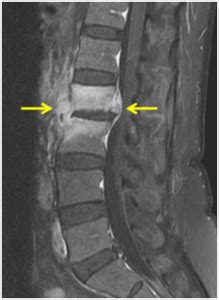 Lumbar Spine Xray Abnormal