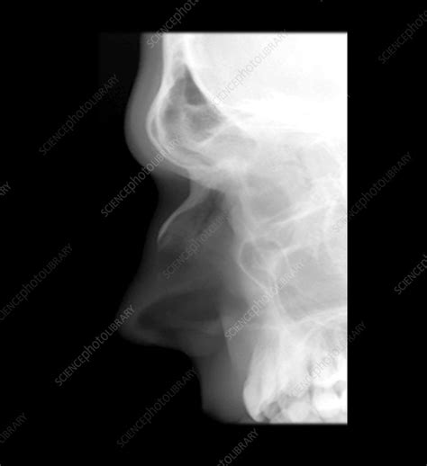 Nasal Bone Xray