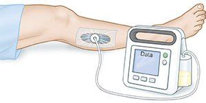 Negative Pressure Wound Therapy - What You Need to Know