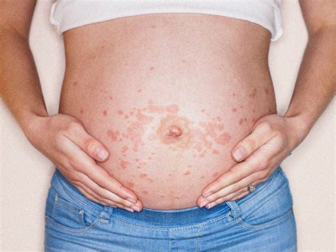 7 types of pregnancy rash: Symptoms and what they look like