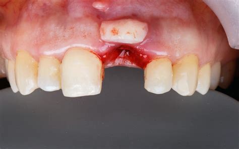 Facts about infection after gum graft infection | newjerseyortho