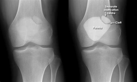 Trauma X-ray - Lower limb gallery 1 - Knee - Bipartite patella