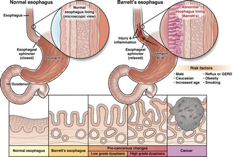 Barrett’s esophagus - AGA GI Patient Center