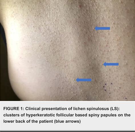 [PDF] An Uncommon Case of Lichen Spinulosus in an Adult Patient Clinically Mmimicking ...