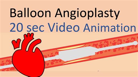 Balloon angioplasty animation (20 seconds) for peripheral vascular disease / coronary artery ...