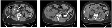 Xanthogranulomatous Pyelonephritis With Extension to the Liver: A Case Report | Cureus